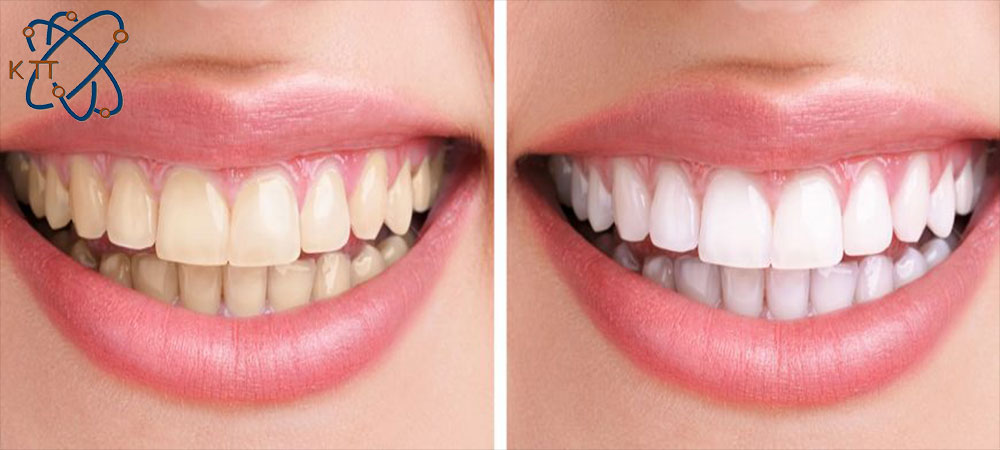 کاربرد پروکساید برای دندانها