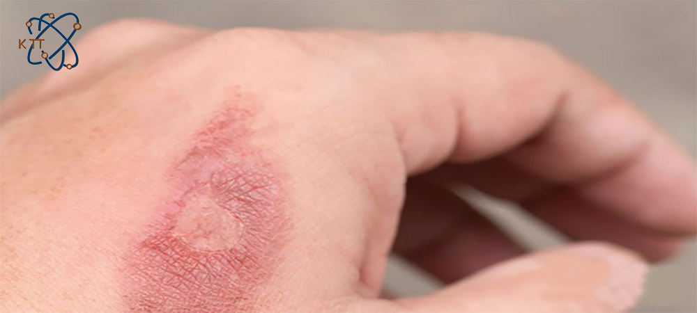 سوختگی پوست دست در تماس با فرمیک اسید