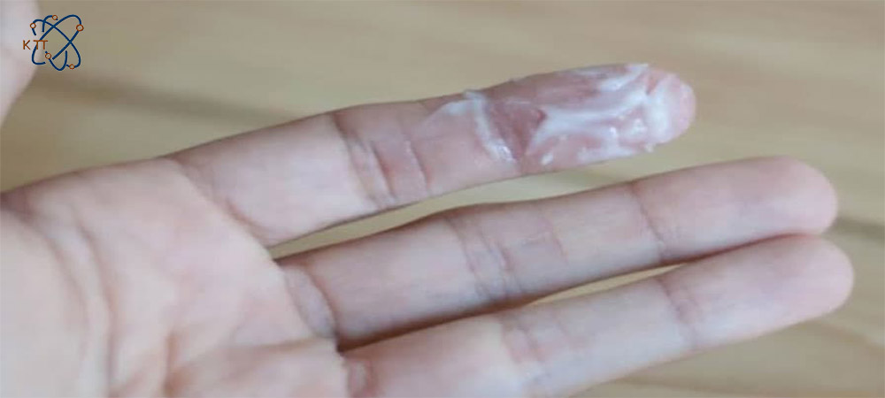 عفونت روی انگشت دست