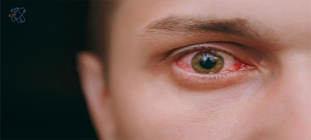 التهاب و قرمزی چشم در صورت تماس هیدروکسید سدیم با چشم