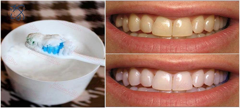 ریختن جوش شیرین روی مسواک در کنار عکس قبل و بعد دندانها