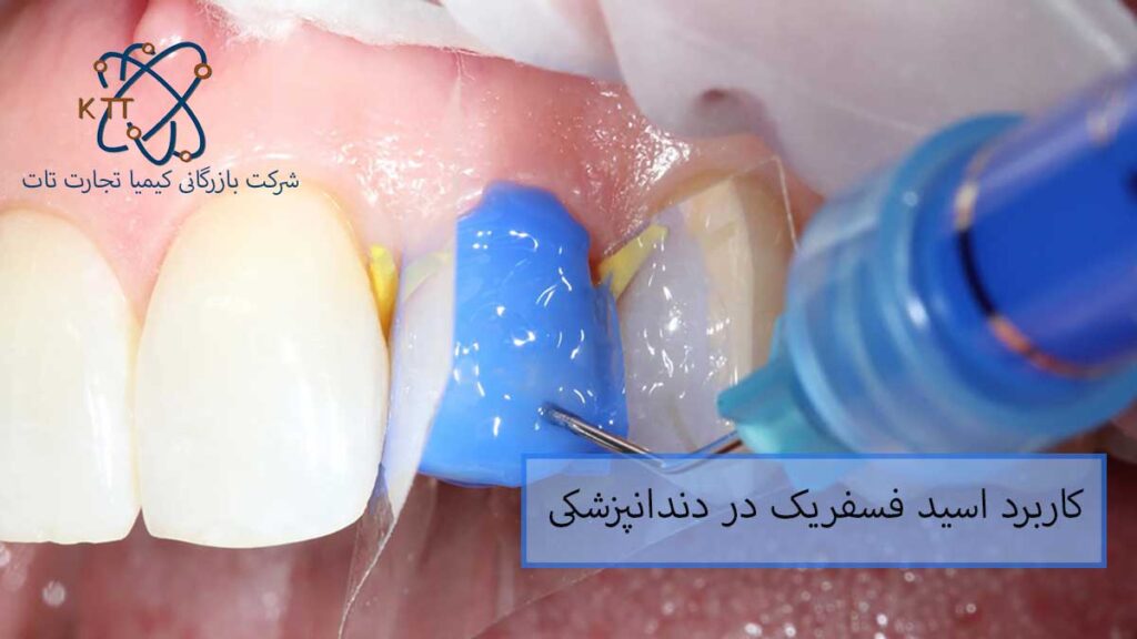 اهمیت و کاربرد اسید فسفریک در دندانپزشکی