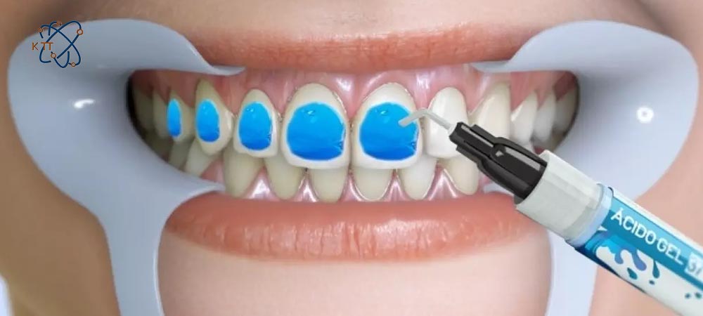 ریختن ژل آبی رنگ حاوی اسید فسفریک بر روی دندنها