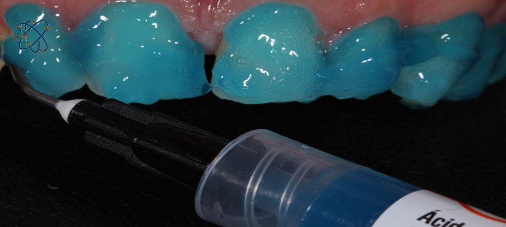 ریختن اسید فسفریک آبی رنگ بر روی دندانها
