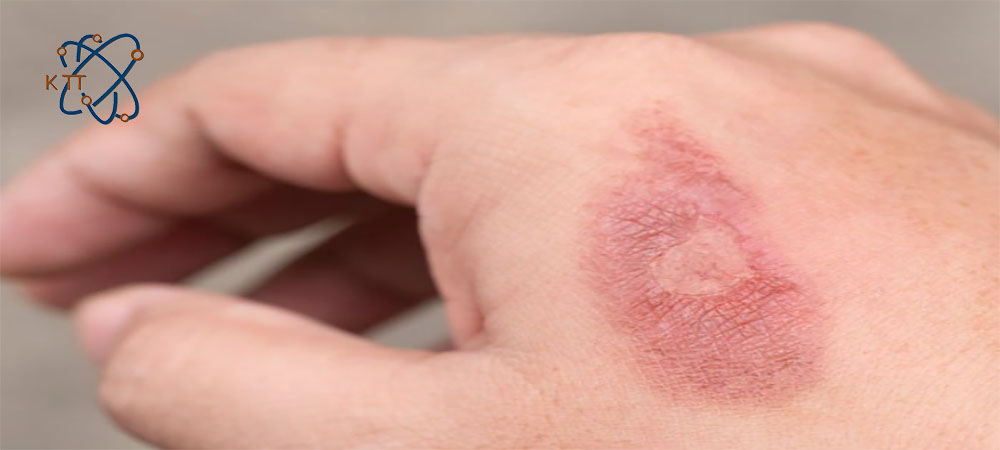 پوست دست سوخته ناشی از تماس با اسید سولفوریک