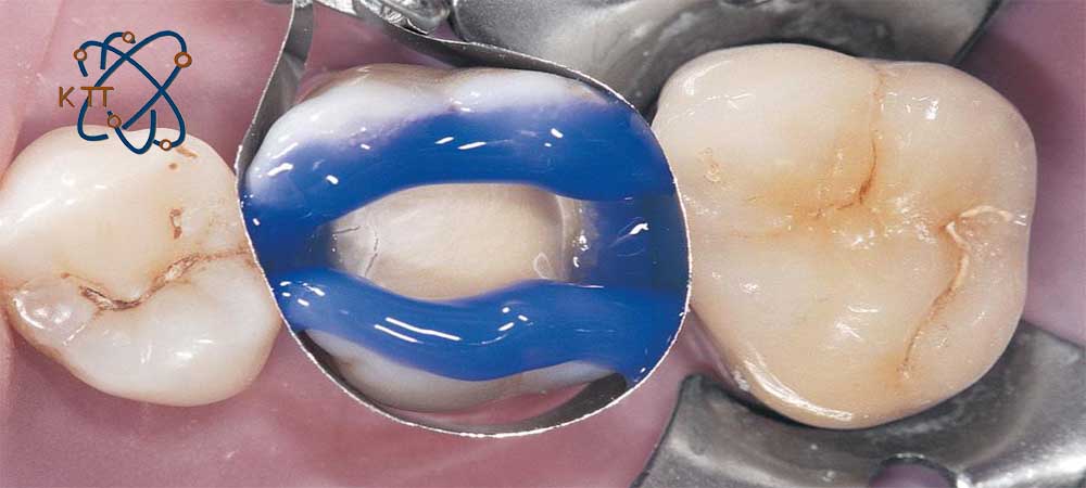 نحوه بکارگیری اسید در دندانپزشکی بوسیله ژل آبی رنگ بر روی یک دندان در میان دو دندان دیگر