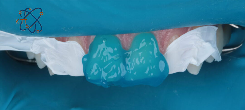 ژل آبی رنگ حاوی اسید فسفریک روی دو دندان جلویی شخصی