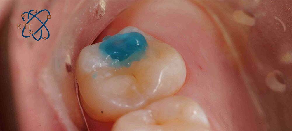 ماده ای آبی رنگ حاوی اسید بر روی دندان خلفی