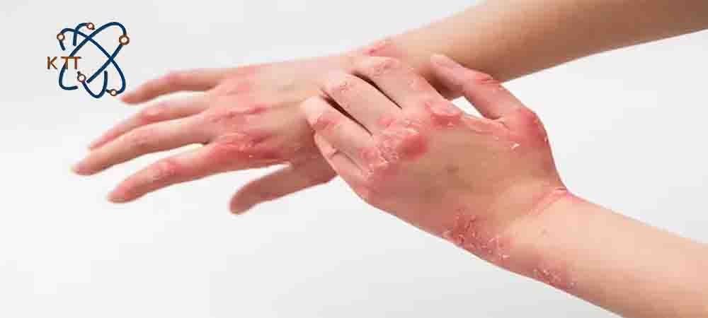 واکنشهای آلرژیک پوستی به شکل کهیر و التهاب در دو دست 